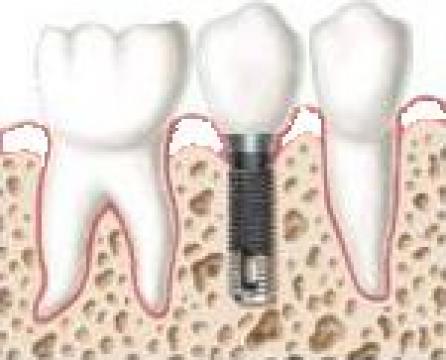 Implant dentar de la Cmi Dr Inisconi Mariana Constantina