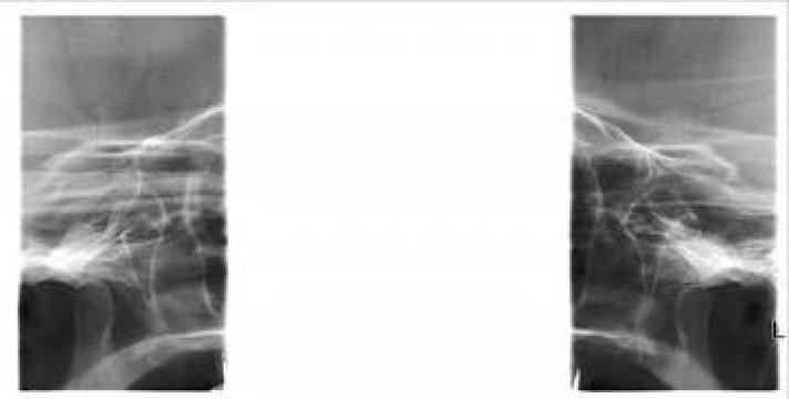 Articulatie temporo-mandibulara TMJ Digital - LAT. si PA. de la Petra Laboratory - Centrul De Radiologie Digitala Stomatolog