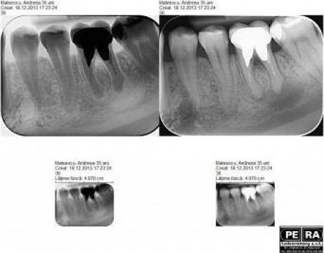 Radiografie dentara digitala RX