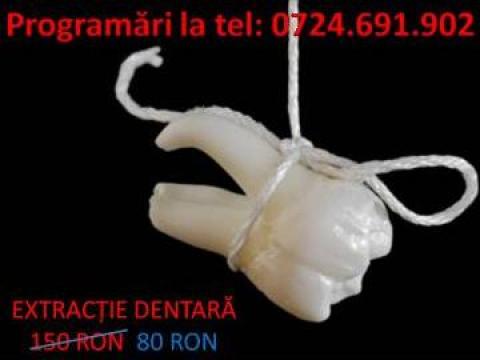 Extractie dentara de la Iuliadent - Medicina Dentara