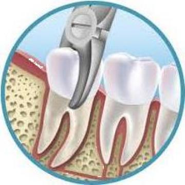 Extractie dentara cabinet stomatologic Targu-Jiu